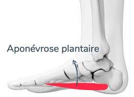 Aponévrosite plantaire